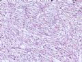 肝肿瘤－－ 肝血管平滑肌脂肪瘤图3
