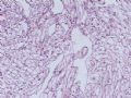 肝肿瘤－－ 肝血管平滑肌脂肪瘤图6