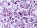 肝肿瘤－－ 肝血管平滑肌脂肪瘤图8