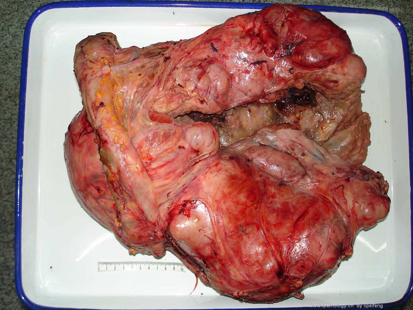 胰腺巨大肿瘤图1