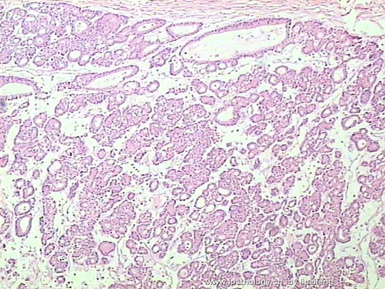 胰腺巨大肿瘤图2