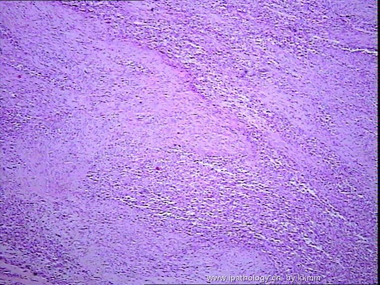 左腘窝肿瘤（P070290）-横纹肌肉瘤图2