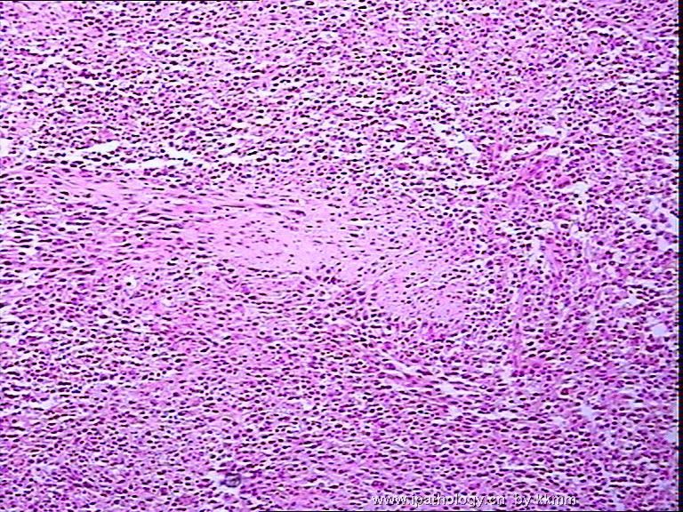 左腘窝肿瘤（P070290）-横纹肌肉瘤图6