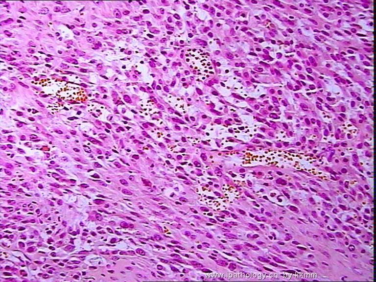 左腘窝肿瘤（P070290）-横纹肌肉瘤图8