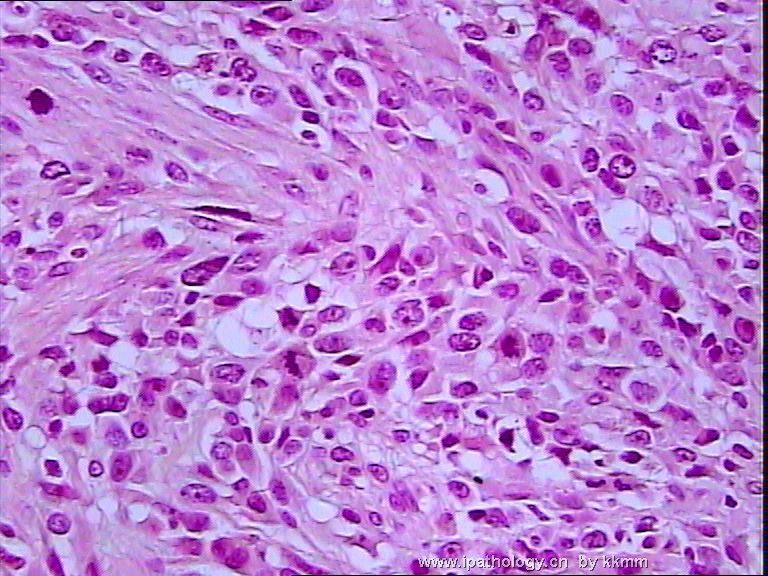 左腘窝肿瘤（P070290）-横纹肌肉瘤图9