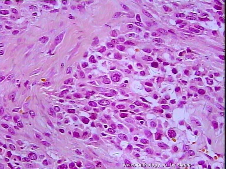左腘窝肿瘤（P070290）-横纹肌肉瘤图10
