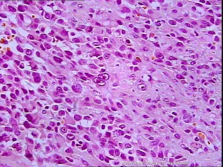 左腘窝肿瘤（P070290）-横纹肌肉瘤图11
