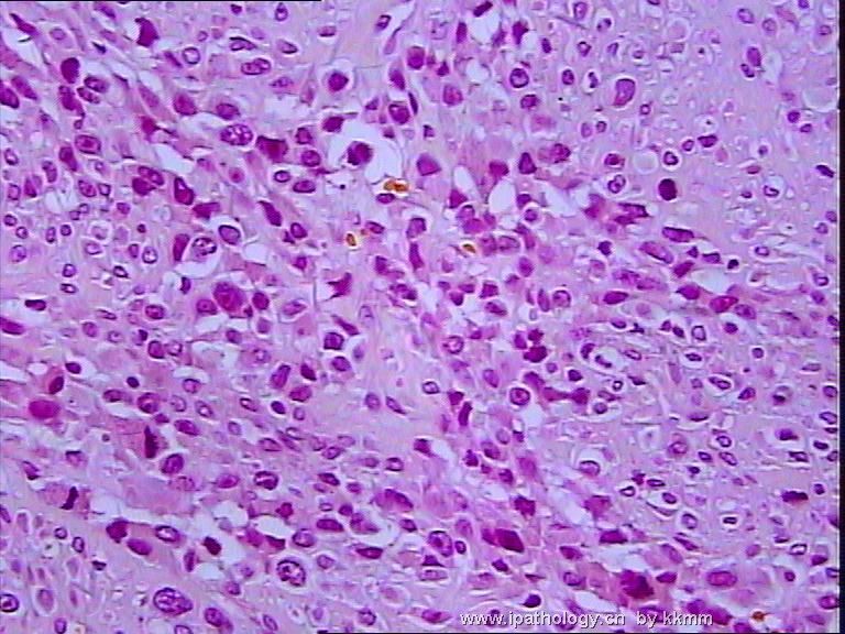 左腘窝肿瘤（P070290）-横纹肌肉瘤图12