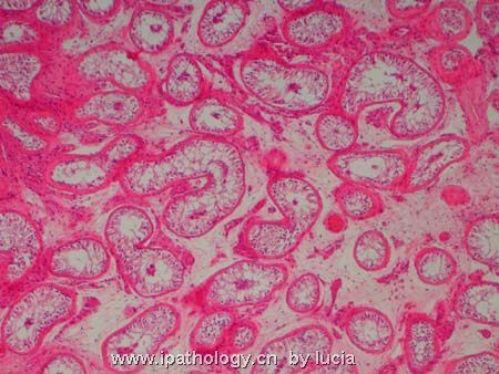 睾丸病变-支持细胞综合征图1