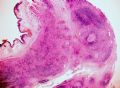 输尿管病变—炎症性肌纤维母细胞瘤图1