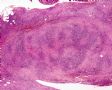 输尿管病变—炎症性肌纤维母细胞瘤图2