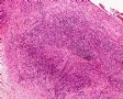 输尿管病变—炎症性肌纤维母细胞瘤图3