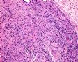 输尿管病变—炎症性肌纤维母细胞瘤图4