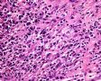 输尿管病变—炎症性肌纤维母细胞瘤图5