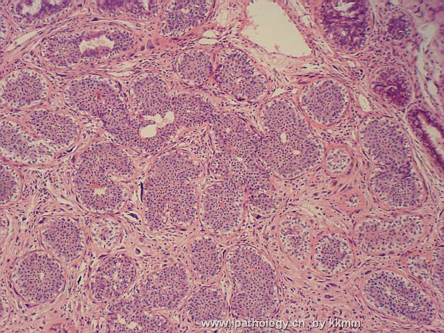 左乳腺肿瘤（P074091）图4