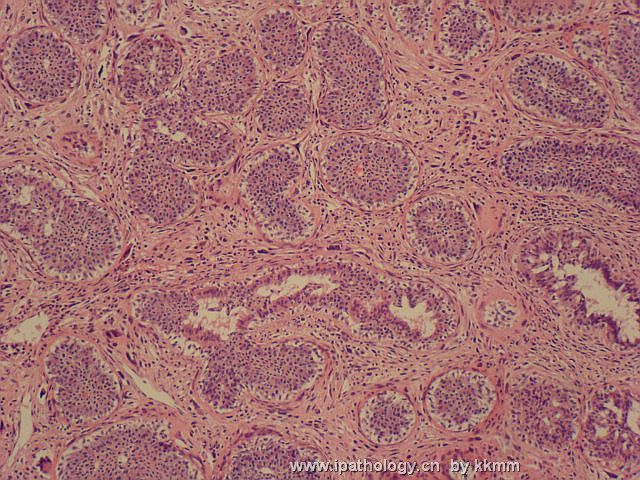 左乳腺肿瘤（P074091）图8