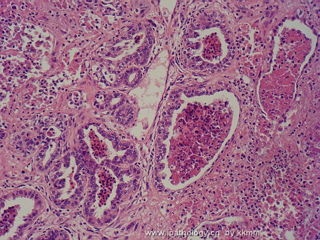 左乳腺肿瘤（P074091）图16