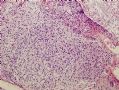请教关于卵巢畸胎瘤中的神经组织的问题图7