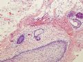 请教关于卵巢畸胎瘤中的神经组织的问题图9