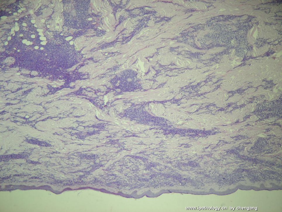 皮肤肿物（会1650－少见的病例）－母细胞性浆细胞样树状突细胞肿瘤(旧称母细胞NK细胞淋巴瘤图1