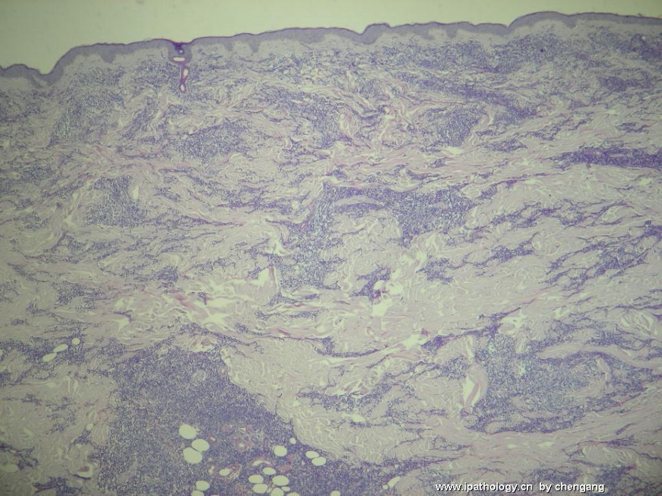 皮肤肿物（会1650－少见的病例）－母细胞性浆细胞样树状突细胞肿瘤(旧称母细胞NK细胞淋巴瘤图2