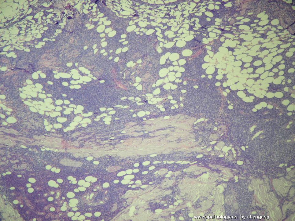 皮肤肿物（会1650－少见的病例）－母细胞性浆细胞样树状突细胞肿瘤(旧称母细胞NK细胞淋巴瘤图3