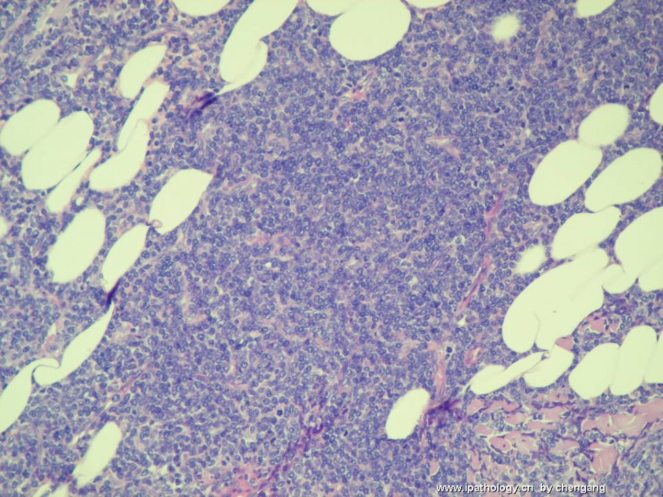 皮肤肿物（会1650－少见的病例）－母细胞性浆细胞样树状突细胞肿瘤(旧称母细胞NK细胞淋巴瘤图4