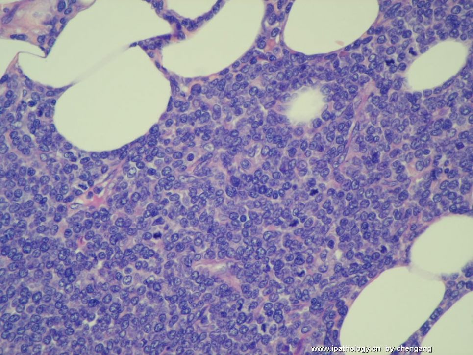 皮肤肿物（会1650－少见的病例）－母细胞性浆细胞样树状突细胞肿瘤(旧称母细胞NK细胞淋巴瘤图5