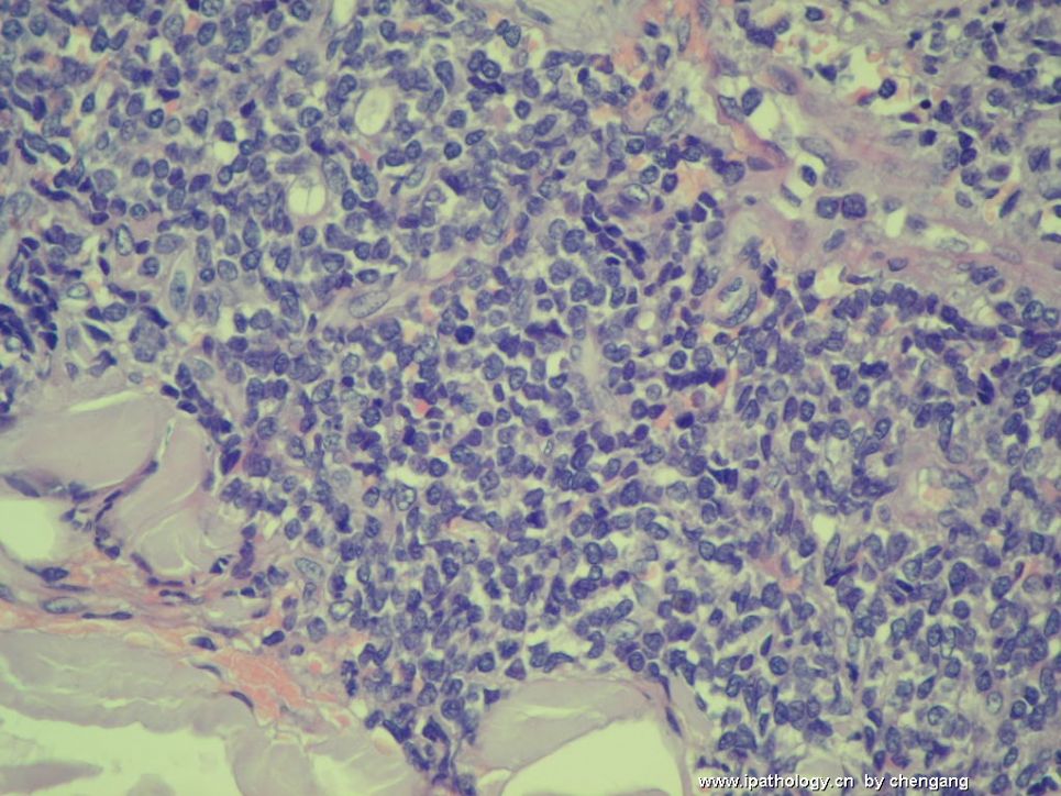 皮肤肿物（会1650－少见的病例）－母细胞性浆细胞样树状突细胞肿瘤(旧称母细胞NK细胞淋巴瘤图6