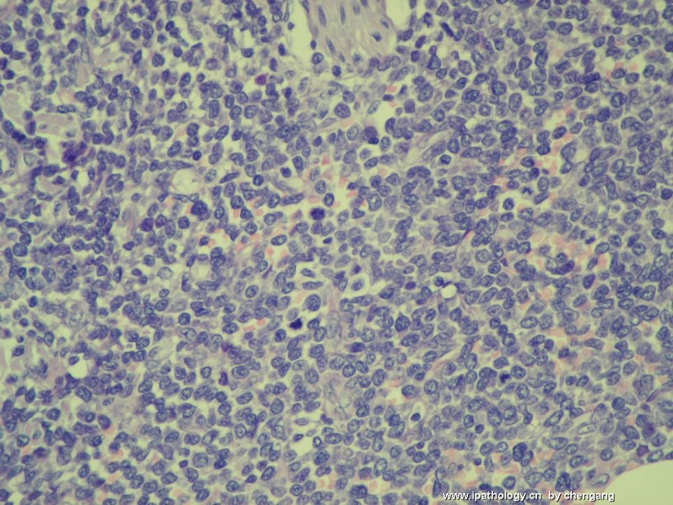 皮肤肿物（会1650－少见的病例）－母细胞性浆细胞样树状突细胞肿瘤(旧称母细胞NK细胞淋巴瘤图7