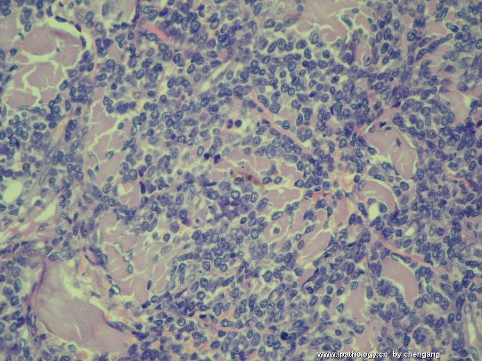 皮肤肿物（会1650－少见的病例）－母细胞性浆细胞样树状突细胞肿瘤(旧称母细胞NK细胞淋巴瘤图8