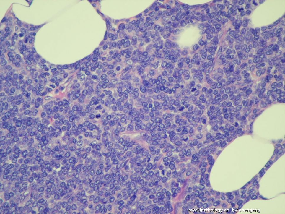 皮肤肿物（会1650－少见的病例）－母细胞性浆细胞样树状突细胞肿瘤(旧称母细胞NK细胞淋巴瘤图9