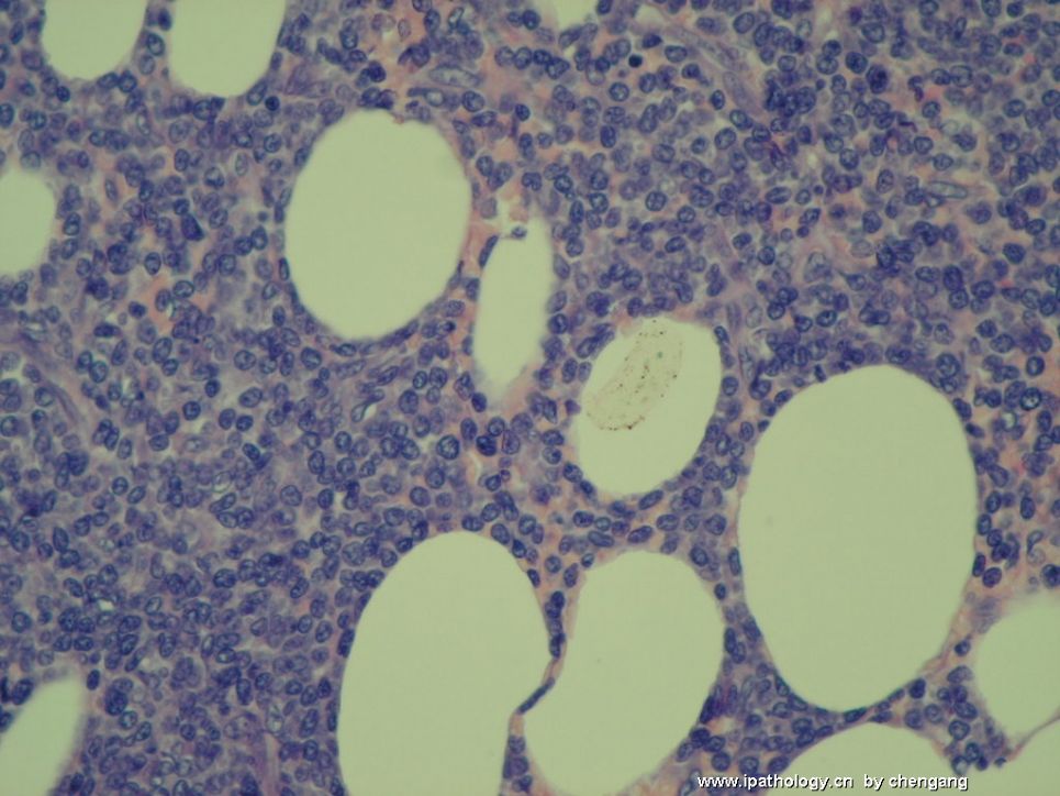 皮肤肿物（会1650－少见的病例）－母细胞性浆细胞样树状突细胞肿瘤(旧称母细胞NK细胞淋巴瘤图10