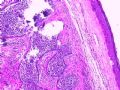 眉弓肿物:毛母细胞癌?图1