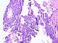 腹膜后肿瘤，一个有意思的病例图5