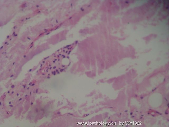 sbvingtun胃大弯与肠系膜之间肿块图12