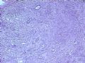乳腺肿瘤－－恶性叶状肿瘤（叶状囊肉瘤）图3