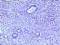 乳腺肿瘤－－恶性叶状肿瘤（叶状囊肉瘤）图4