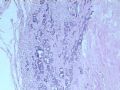 乳腺肿瘤－－发生在乳腺纤维腺瘤中的癌图1