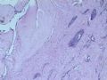 乳腺肿瘤－－发生在乳腺纤维腺瘤中的癌图2