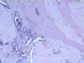 乳腺肿瘤－－发生在乳腺纤维腺瘤中的癌图3