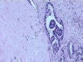 乳腺肿瘤－－发生在乳腺纤维腺瘤中的癌图7