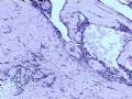 乳腺肿瘤－－发生在乳腺纤维腺瘤中的癌图9