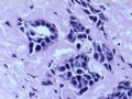 乳腺肿瘤－－发生在乳腺纤维腺瘤中的癌图11
