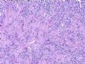 脑膜复发性肿瘤图9