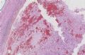 (转贴）左踝部肿块－－伴有病毒细胞或R-S细胞样细胞的炎性粘液样肿瘤图2