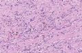 (转贴）左踝部肿块－－伴有病毒细胞或R-S细胞样细胞的炎性粘液样肿瘤图21