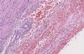 (转贴）左踝部肿块－－伴有病毒细胞或R-S细胞样细胞的炎性粘液样肿瘤图23