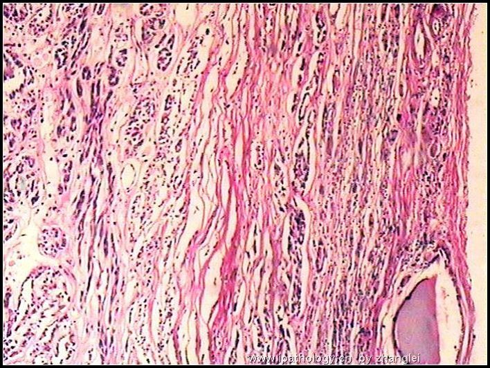 左肾占位--粘液样小管和梭形细胞癌（mucinous tubular and spindle cell carcinoma）图1