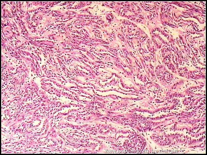 左肾占位--粘液样小管和梭形细胞癌（mucinous tubular and spindle cell carcinoma）图2